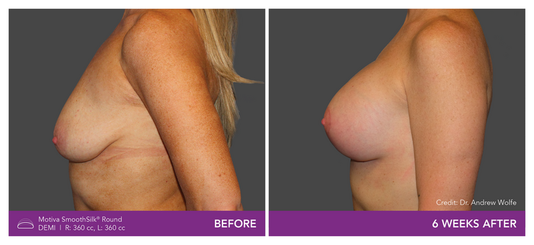 Before and after of Motiva Implants Round Demi side view