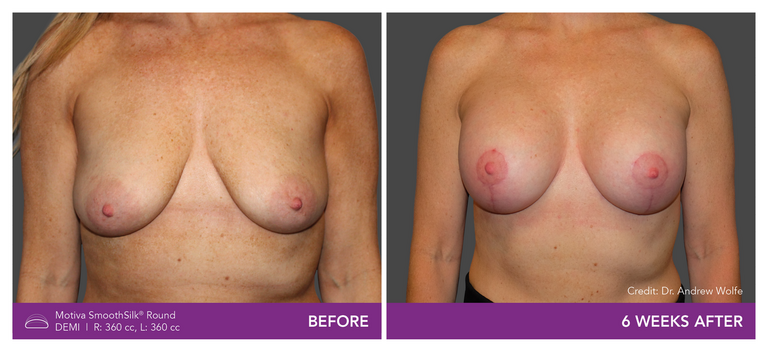 Before and after of Motiva Implants Round Demi front view
