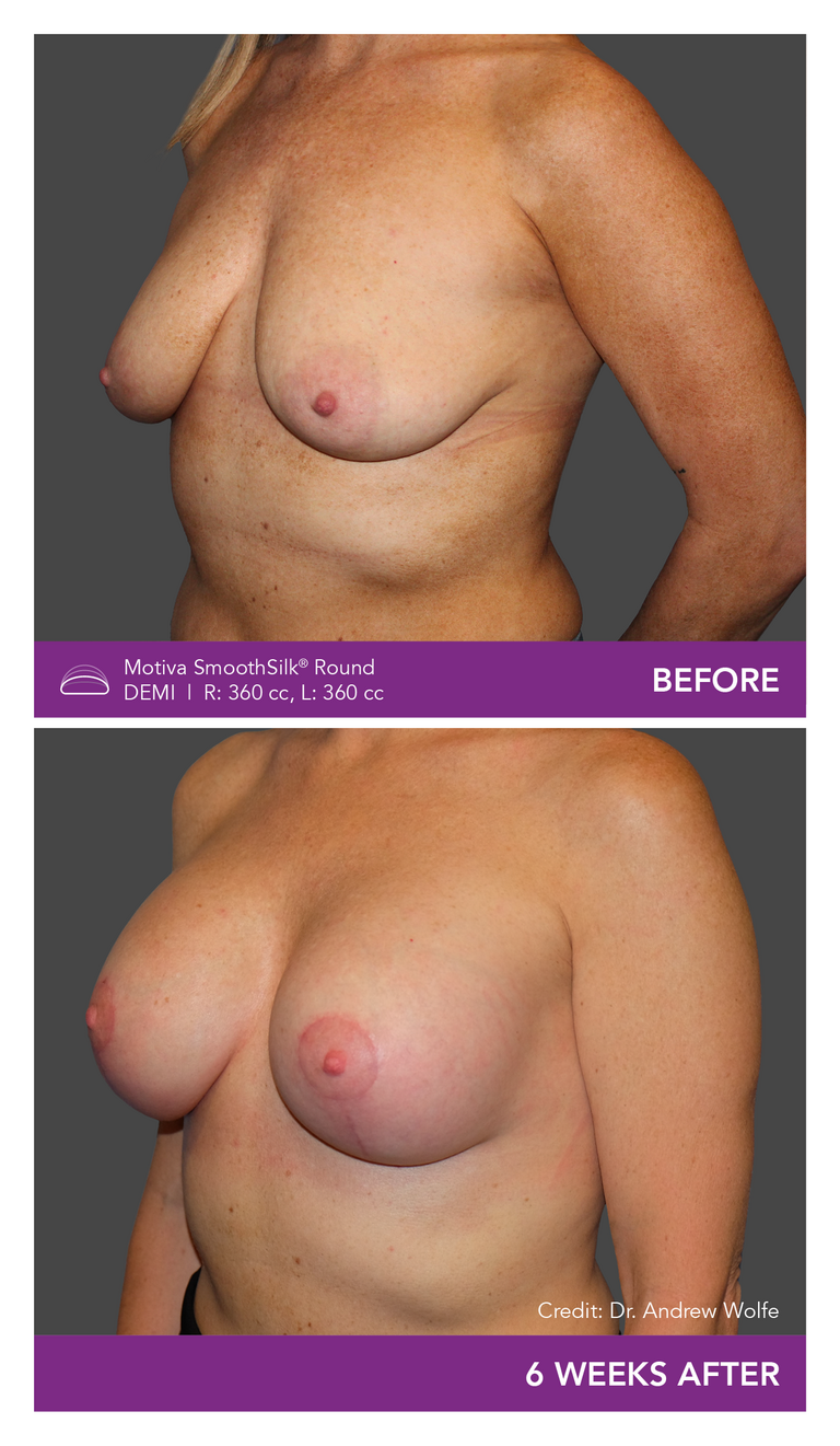 Before and after of Motiva Implants Round Demi angled view