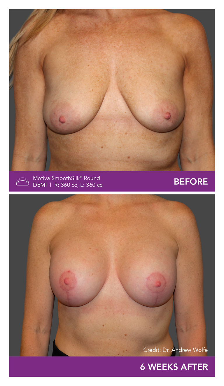 Before and after of Motiva Implants Round Demi front view