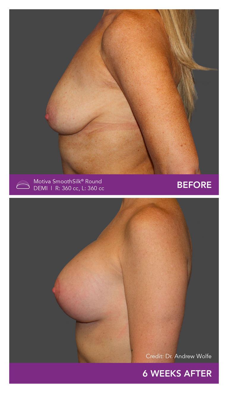 Before and after of Motiva Implants Round Demi side view