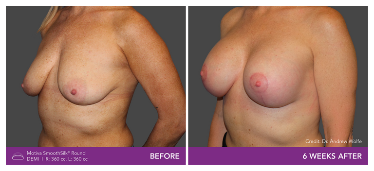 Before and after of Motiva Implants Round Demi angled view
