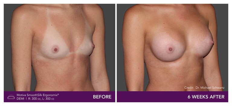 Patient Motiva Ergonomix Demi Implants Before and After - Angled View