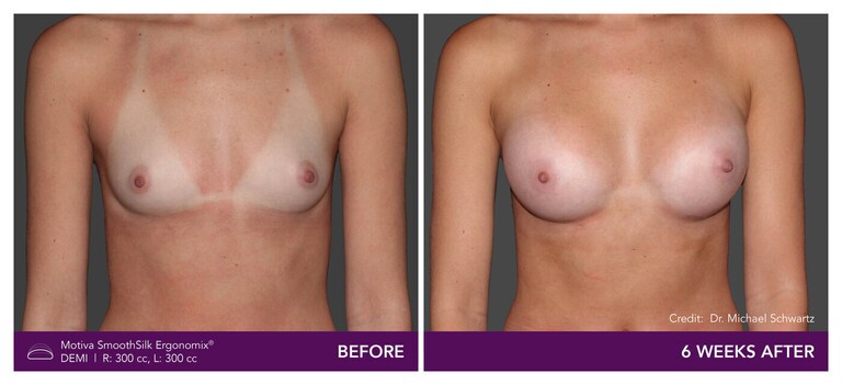 Patient Motiva Ergonomix Demi Implants Before and After - Front View