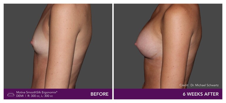 Patient Motiva Ergonomix Demi Implants Before and After - Side View