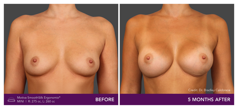 Motiva SmoothSilk Ergonomix Mini Before and After Front View