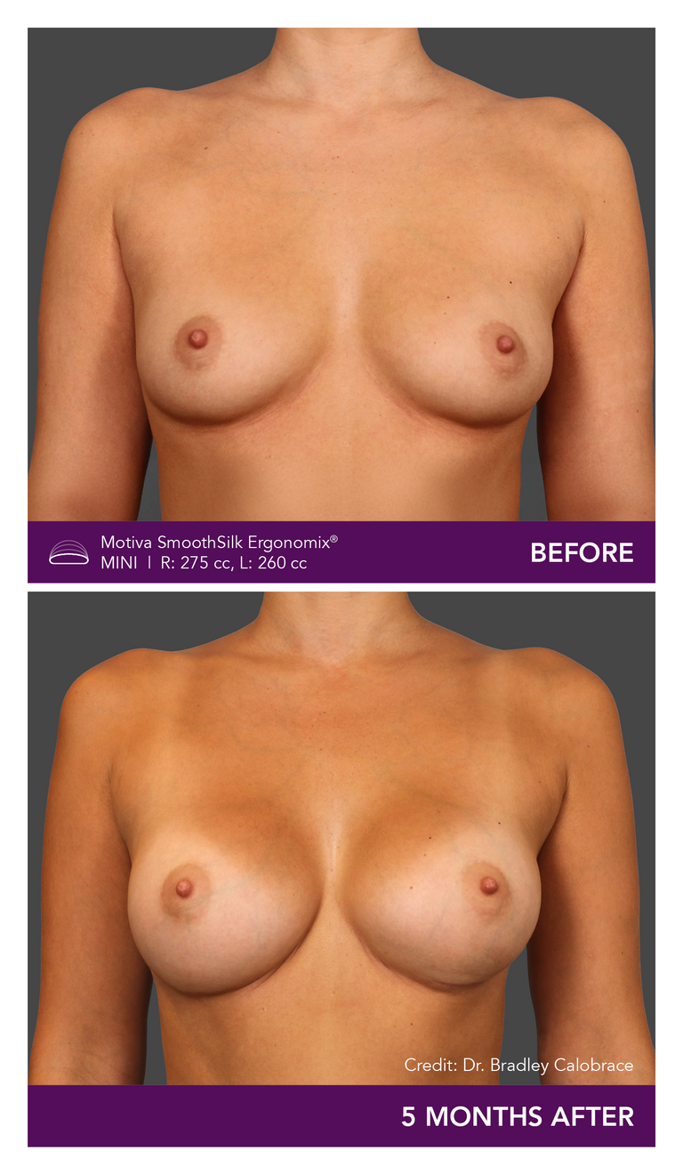 Motiva SmoothSilk Ergonomix Mini Before and After Front View