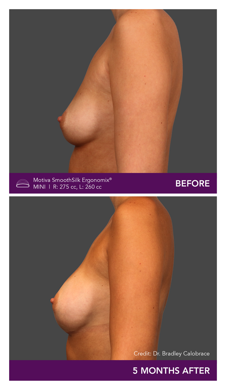 Motiva SmoothSilk Ergonomix Mini Before and After Side View