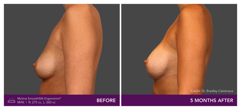 Motiva SmoothSilk Ergonomix Mini Before and After Side View