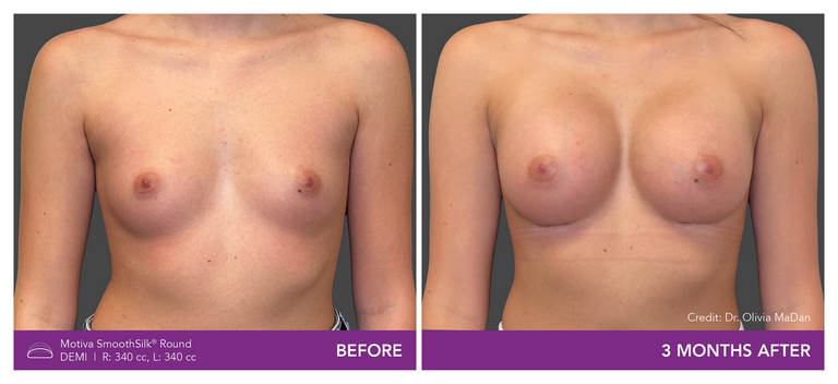 Dr. Olivia MaDan Patient Before and After Front View