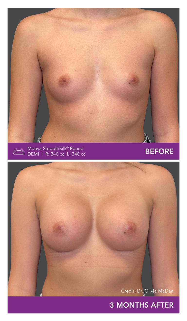 Dr. Olivia MaDan Patient Before and After Mobile Front View