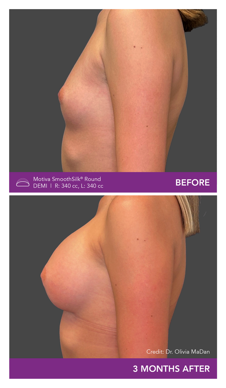 Dr. Olivia MaDan Patient Before and After Mobile Side View