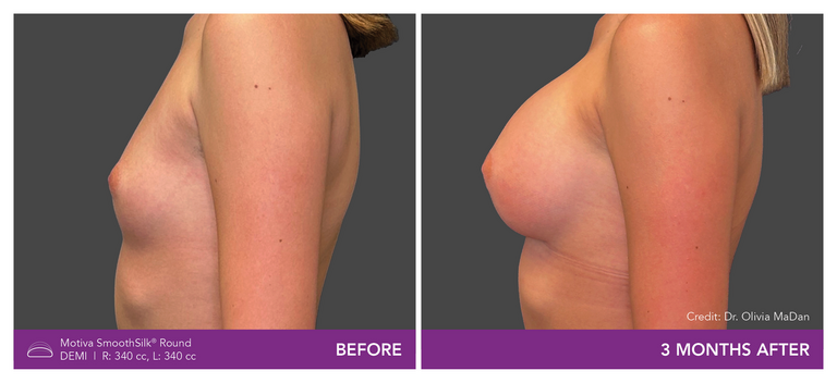 Dr. Olivia MaDan Patient Before and After Side View