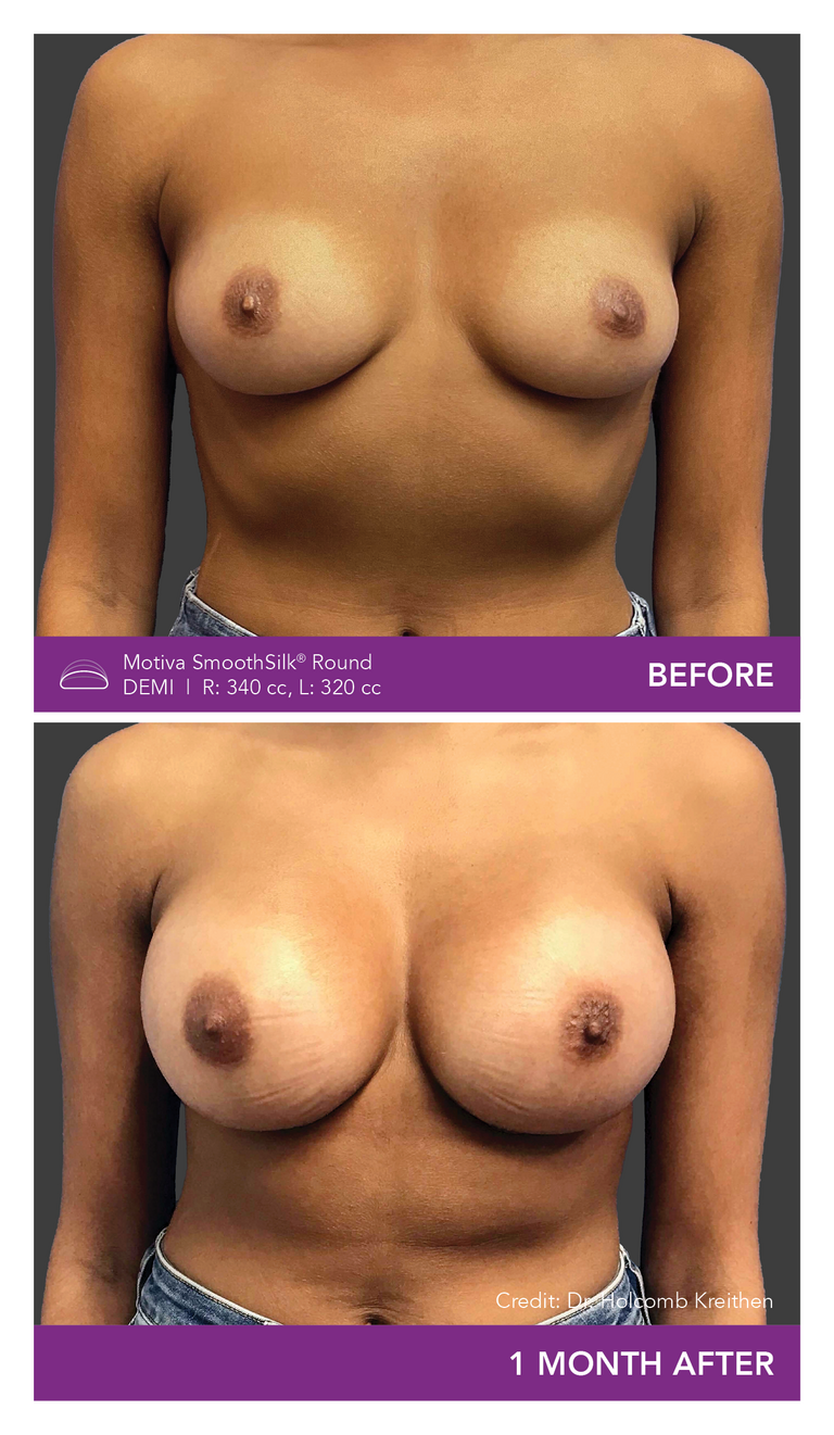 Before and After Images of Round Demi Implant Front view