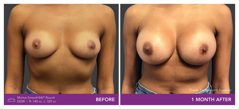 Before and After Images of Round Demi Implant Front view