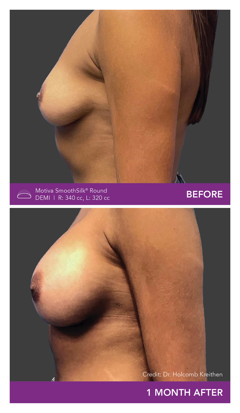 Before and After Images of Round Demi Implant Side View