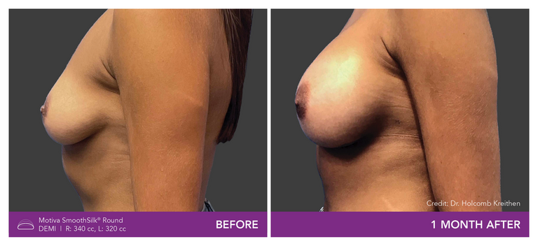 Before and After Images of Round Demi Implant Side View