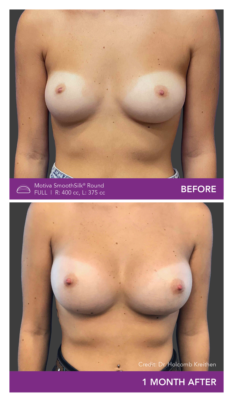 Before and After Images of Round Full Implant Front View