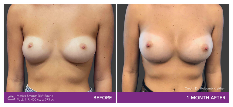 Before and After Images of Round Full Implant Front View