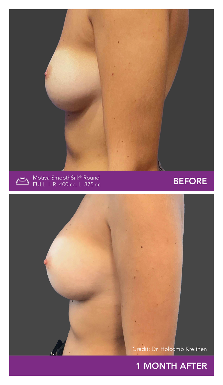 Before and After Images of Round Full Implant Side View