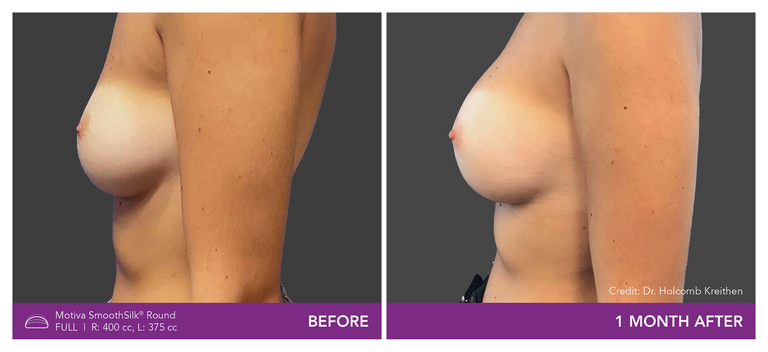 Before and After Images of Round Full Implant Side View