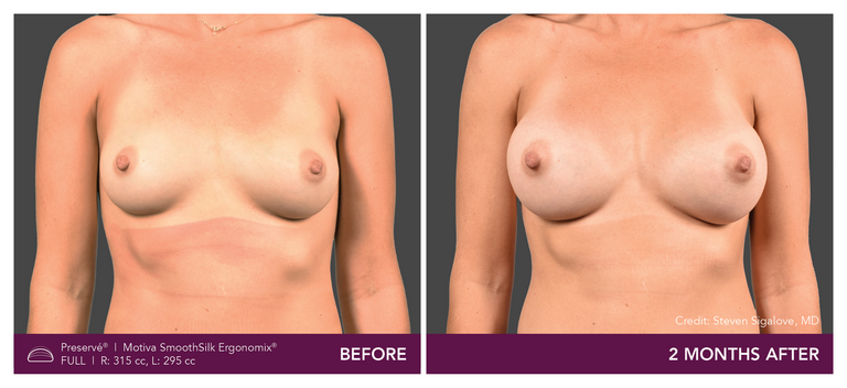 Motiva breast augmentation with Preservé