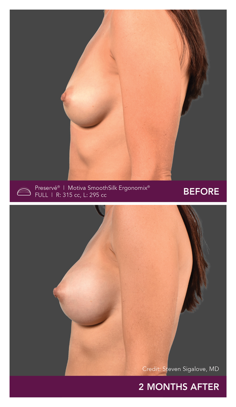 Motiva breast augmentation with Preservé from the side