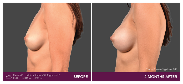 Motiva breast augmentation with Preservé from the side