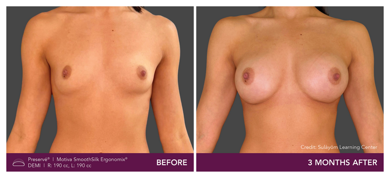 Before and after results of a patient with Motiva implants using Preservé from the front