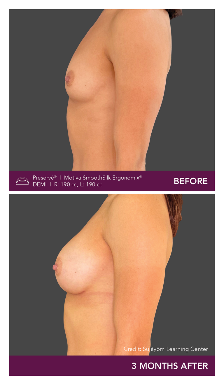 Before and after results of a patient with Motiva implants using Preservé from the side