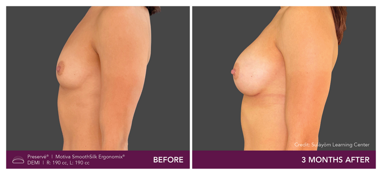 Before and after results of a patient with Motiva implants using Preservé from the side