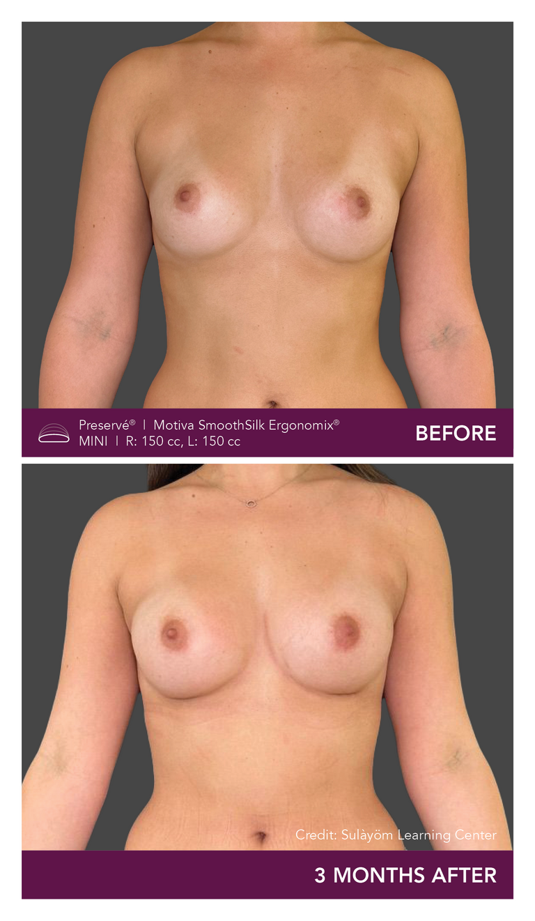 Before and after results of a patient with Motiva implants using Preservé from the front