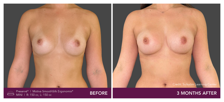 Before and after results of a patient with Motiva implants using Preservé from the front