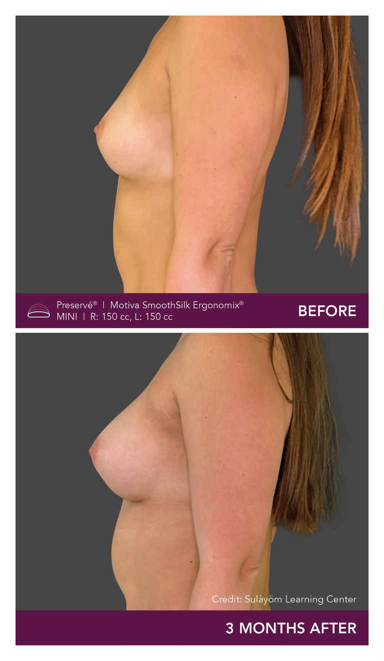 Before and after results of a patient with Motiva implants using Preservé from the side