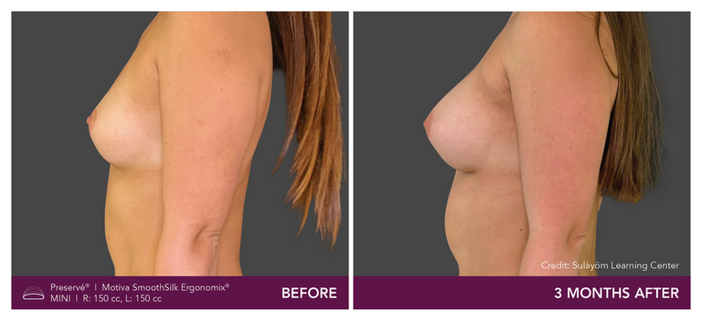 Before and after results of a patient with Motiva implants using Preservé from the side