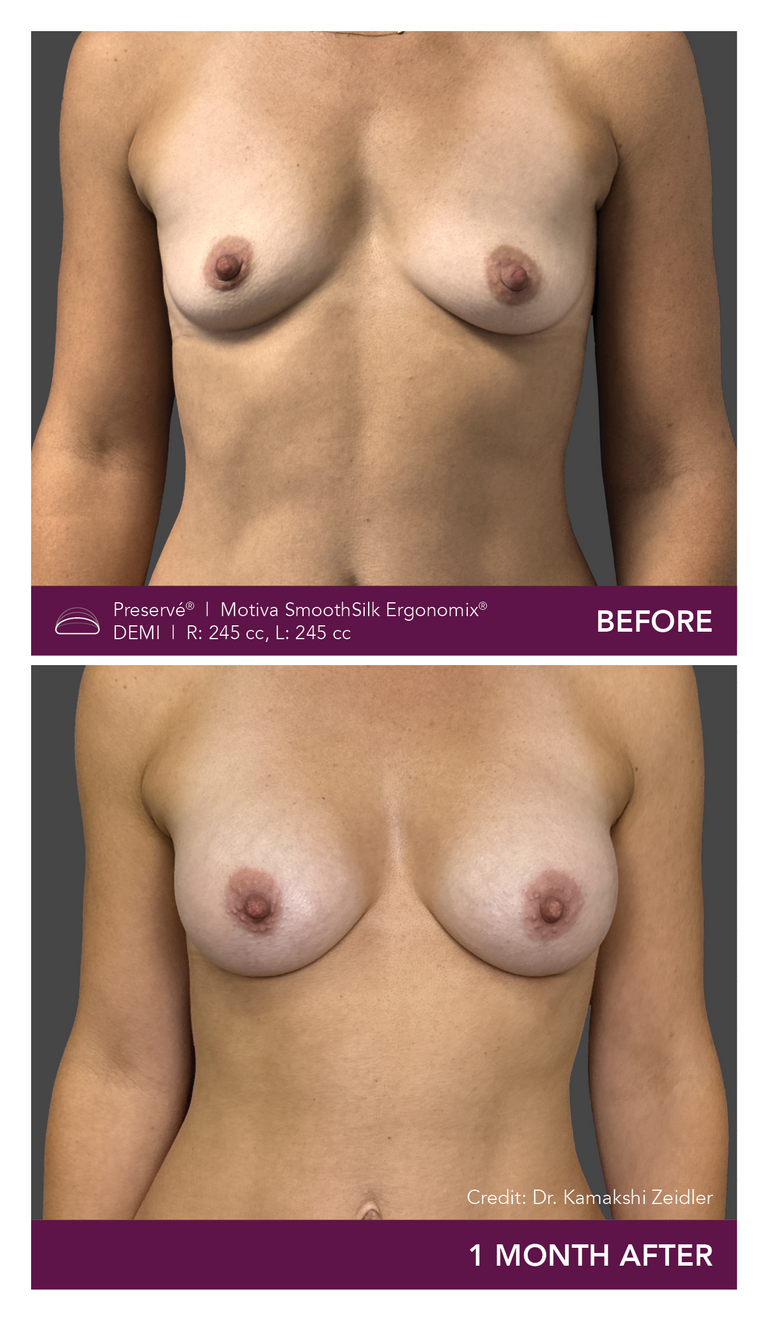 Patient Preserve Before and Afters Demi Projection Front View Mobile