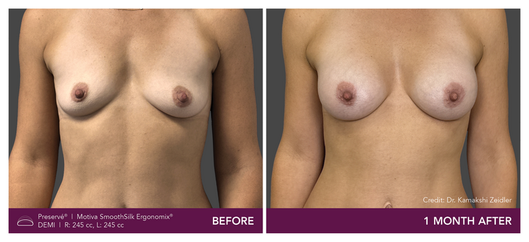 Patient Preserve Before and Afters Demi Projection Front View