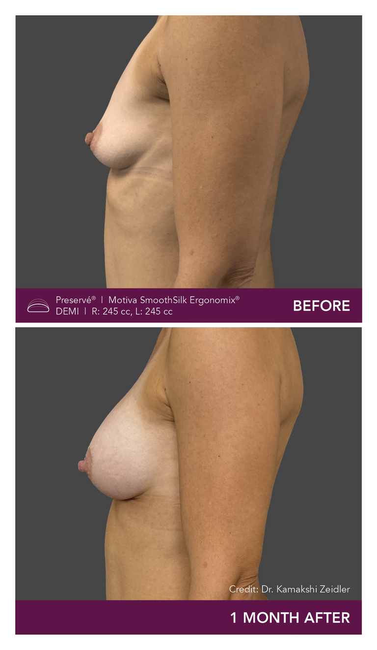 Patient Preserve Before and Afters Demi Projection Side View Mobile