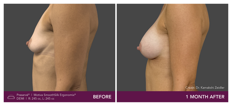 Patient Preserve Before and Afters Demi Projection Side View