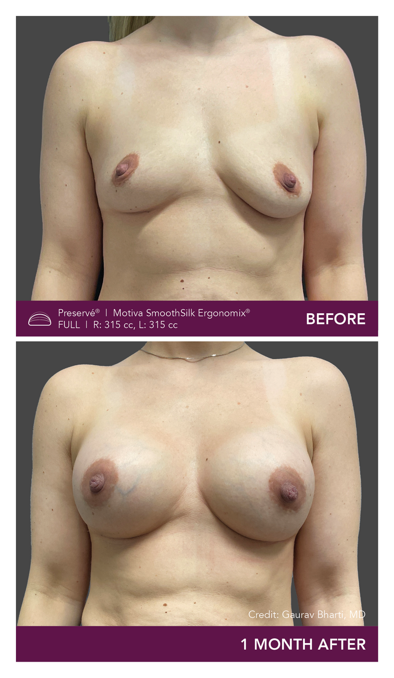 Patient Preserve Before and Afters Full Projection Front View Mobile