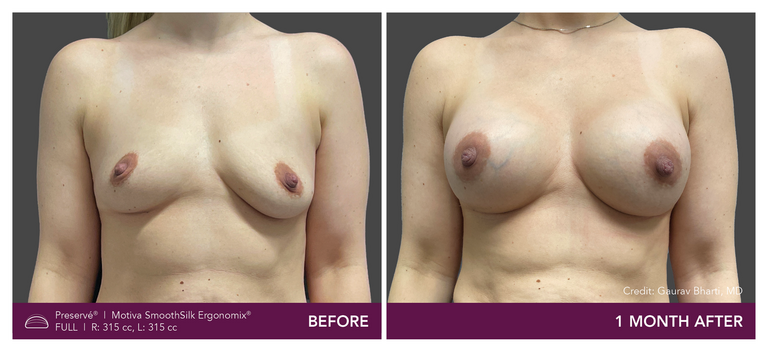 Patient Preserve Before and Afters Full Projection Front View