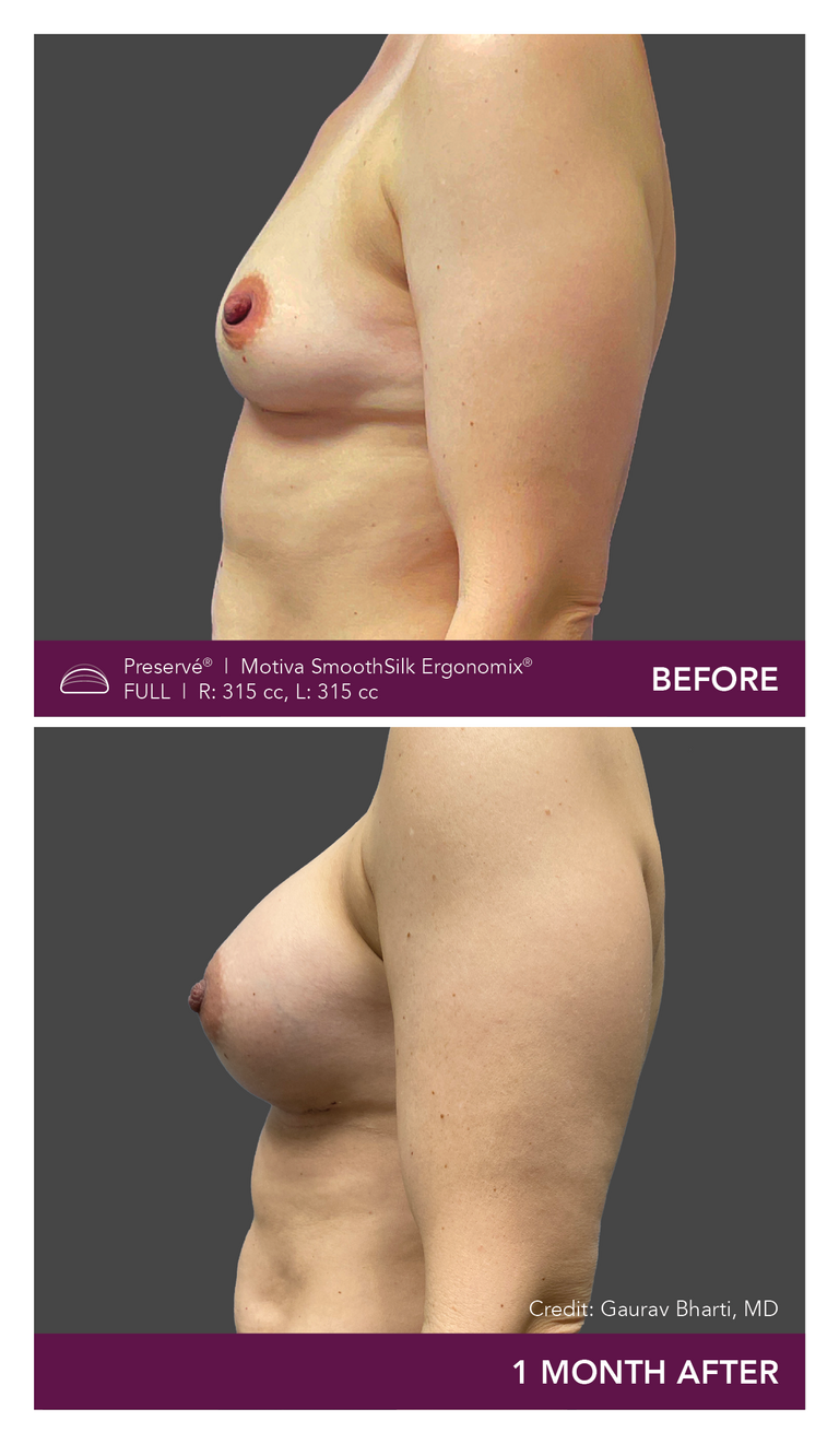 Patient Preserve Before and Afters Full Projection Front View Mobile