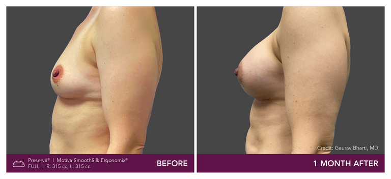 Patient Preserve Before and Afters Full Projection Side View