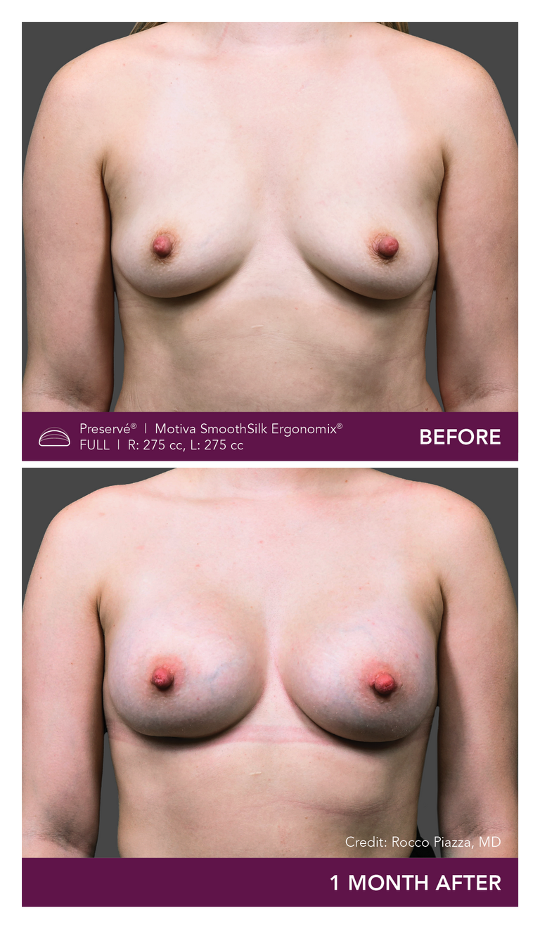 Patient Preserve Before and Afters Full Projection Front View Mobile