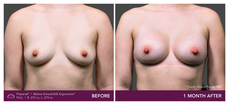 Patient Preserve Before and Afters Full Projection Front View