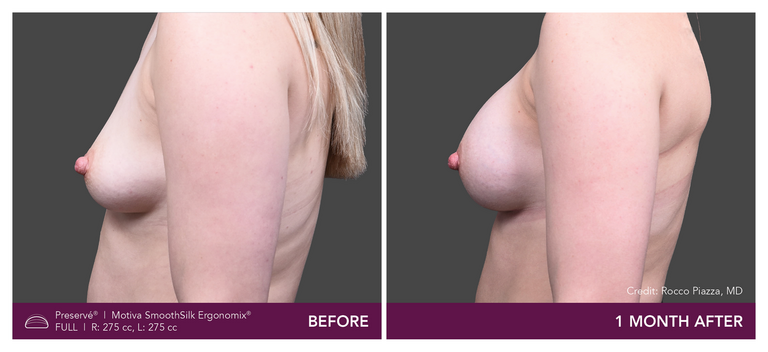 Patient Preserve Before and Afters Full Projection Side View