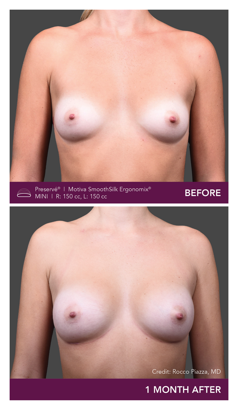 Patient Preserve Before and Afters Mini Projection Front View Mobile