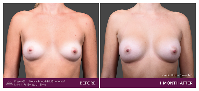 Patient Preserve Before and Afters Mini Projection Front View