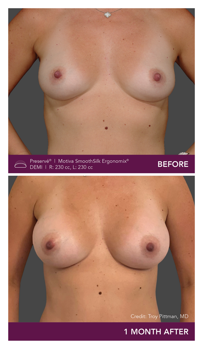 Patient Preserve Before and Afters Demi Projection Front View Mobile