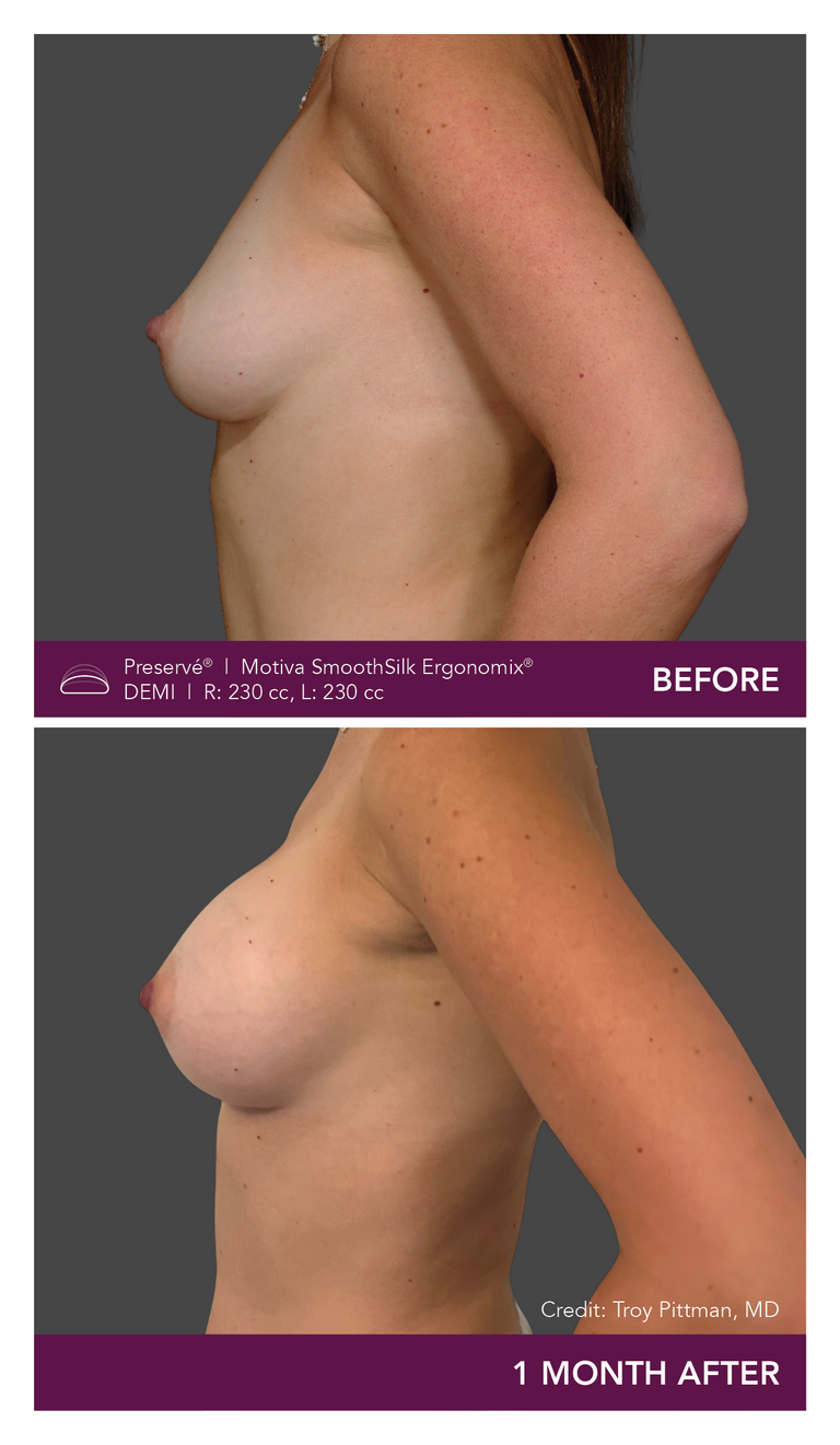 Patient Preserve Before and Afters Demi Projection Side View Mobile